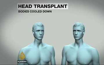 Ca phẫu thuật ghép đầu người đầu tiên sẽ được thực hiện trên một bệnh nhân người Trung Quốc. Ảnh minh họa
